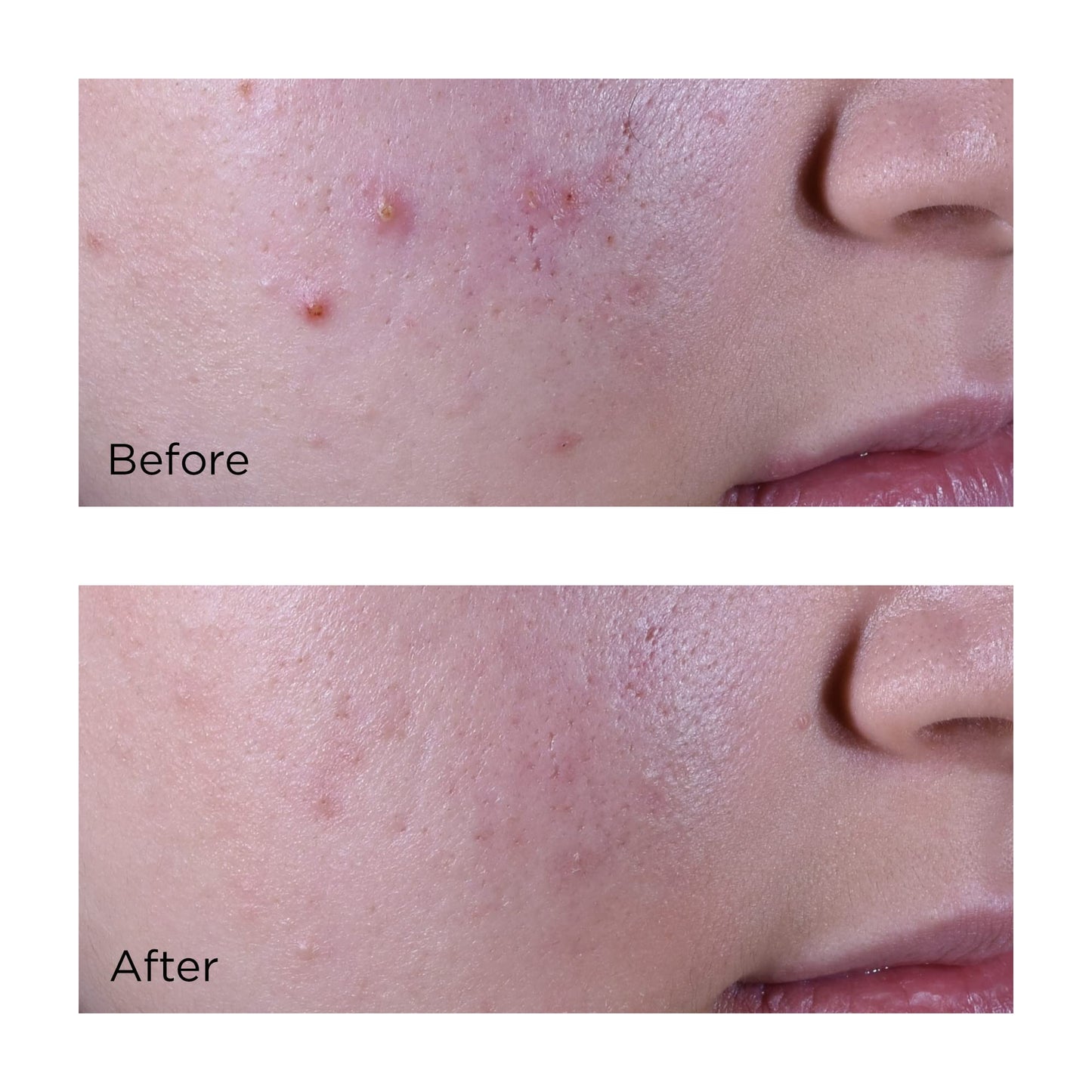 Acne Relief Maximum Strength Clearing Treatment