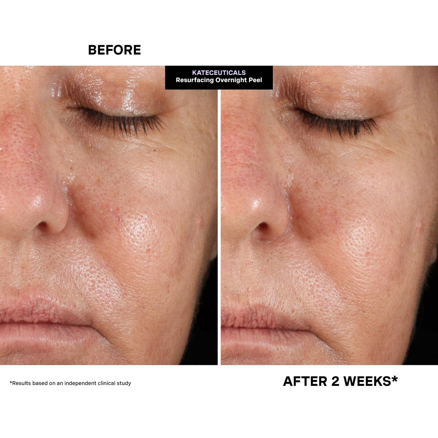 Kate Somerville KateCeuticals® Resurfacing Overnight Peel – Clinic-Grade Face Peel, Powerful Anti-Aging Treatment, 1 Fl Oz