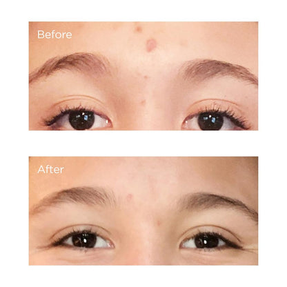 Acne Relief Prebiotic Acne Therapy