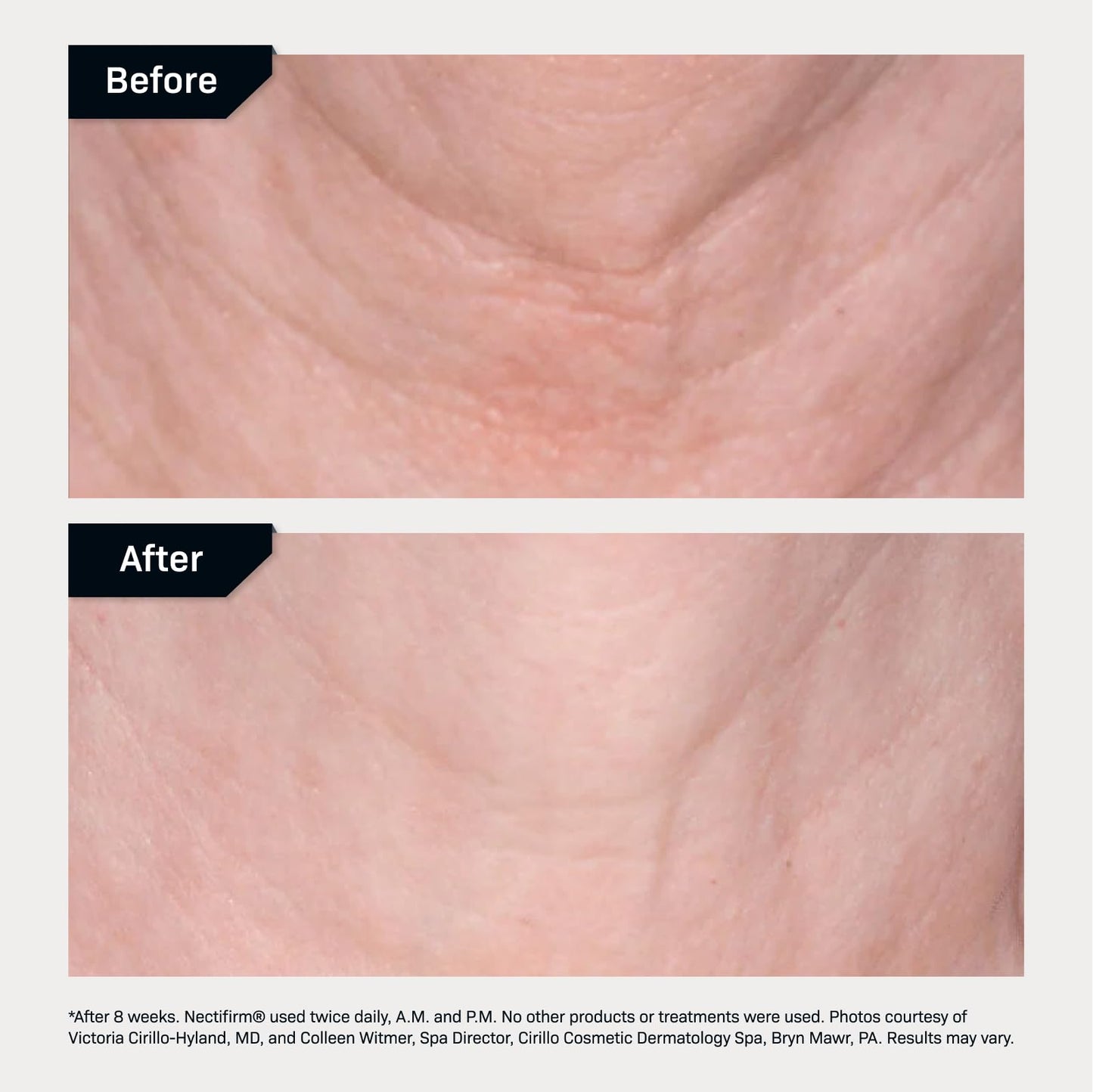 Revision Skincare Nectifirm® Neck Cream – Clinically Proven to Firm, Lift & Smooth the Neck and Jawline, Brightening Skin and Reducing Early Signs of Aging