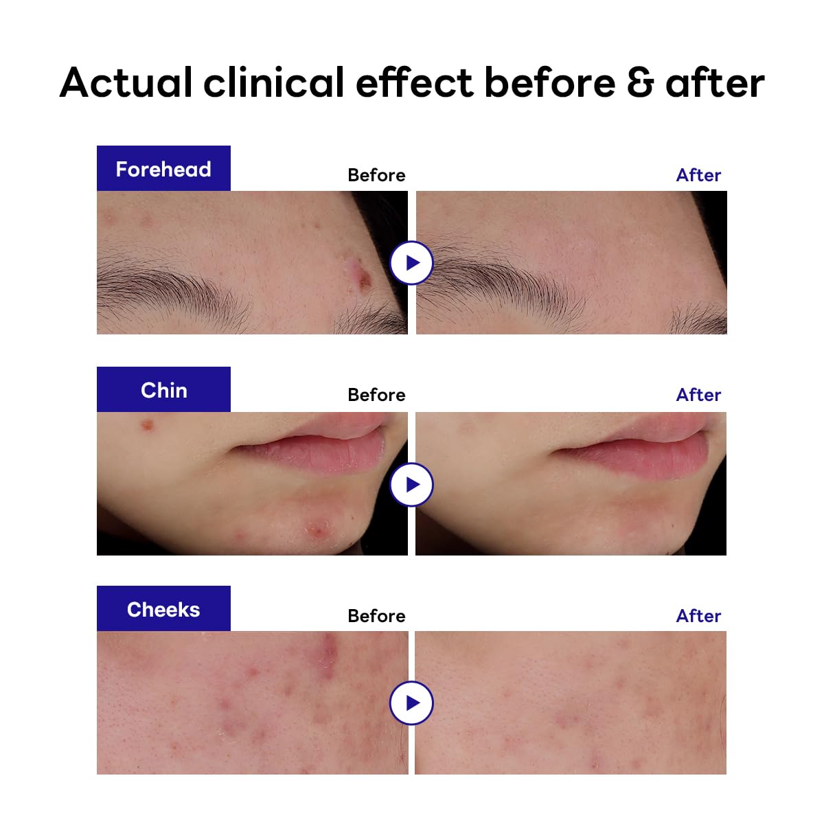 Mediheal Derma Clear Madecassoside Blemish Spot Patch (44 Counts) - Acne Spot Protection, Spot Fast Healing with Madecassoside & Niacinamide