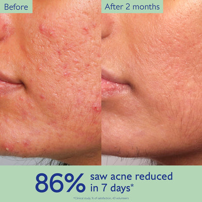 Caudalie Vinopure Acne Treatment, Salicylic Acid Serum to Treat and Prevent Blemishes - 30 mL