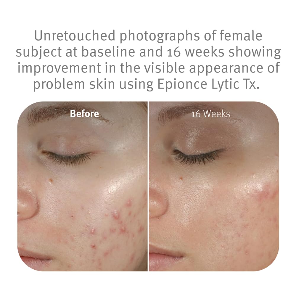 Epionce Lytic Tx - Product for Combination to Oily & Problem Skin with Salicylic Acid, Hyaluronic Acid & Azelaic Acid, Dermatologist Skincare