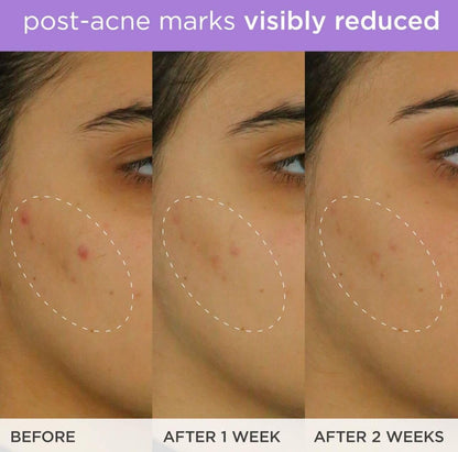The Brightening Serum | Vitamin C Treatment for Brighter, Firmer Skin – Targets Hyperpigmentation & Fades Post-Acne Marks, 30 ml / 1.0 fl. oz.