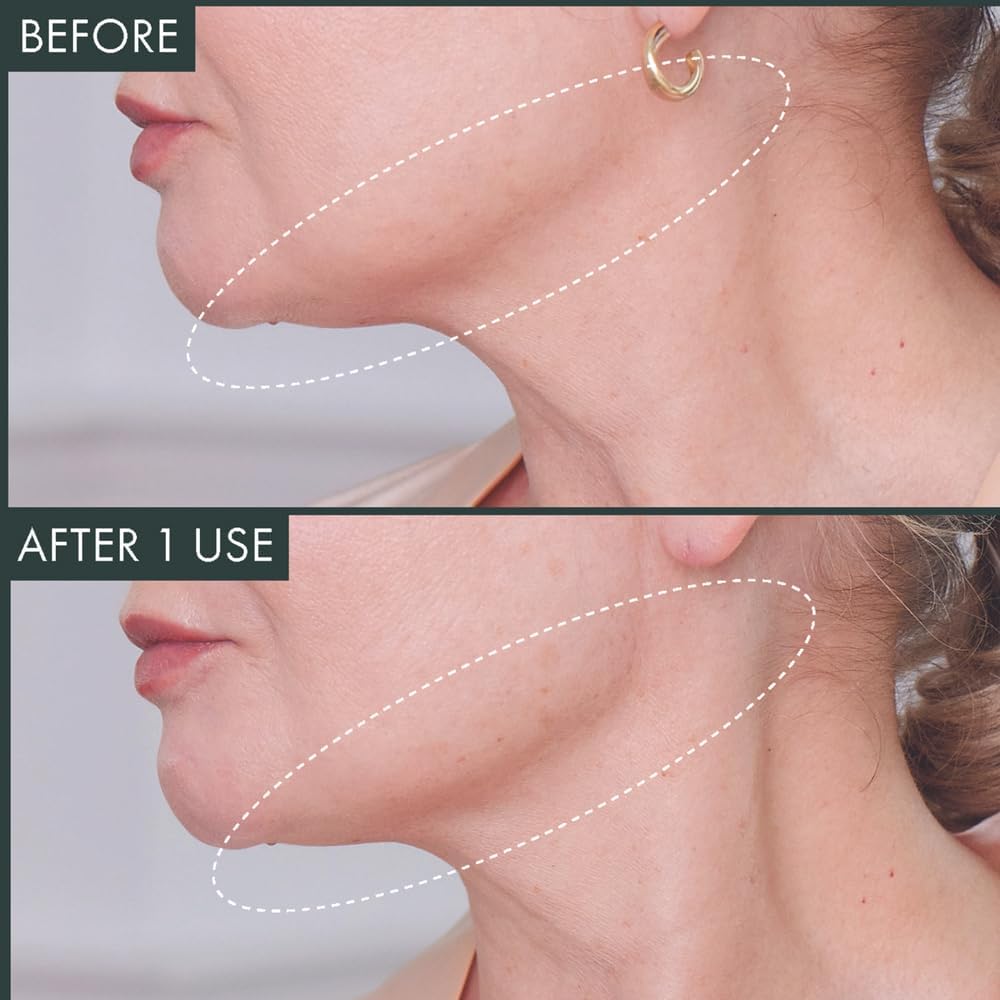 RéVive Neck & Chin Mask - Fermitif Jawline Shaper to Help Sculpt, Tone & Define Neck and Facial Skin - Helps to Improve the Appearance of Fine Lines, Wrinkles & Skin Texture