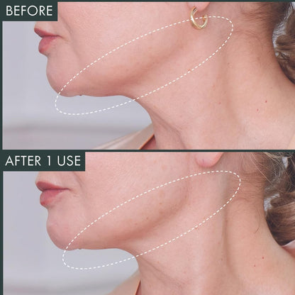 RéVive Neck & Chin Mask - Fermitif Jawline Shaper to Help Sculpt, Tone & Define Neck and Facial Skin - Helps to Improve the Appearance of Fine Lines, Wrinkles & Skin Texture