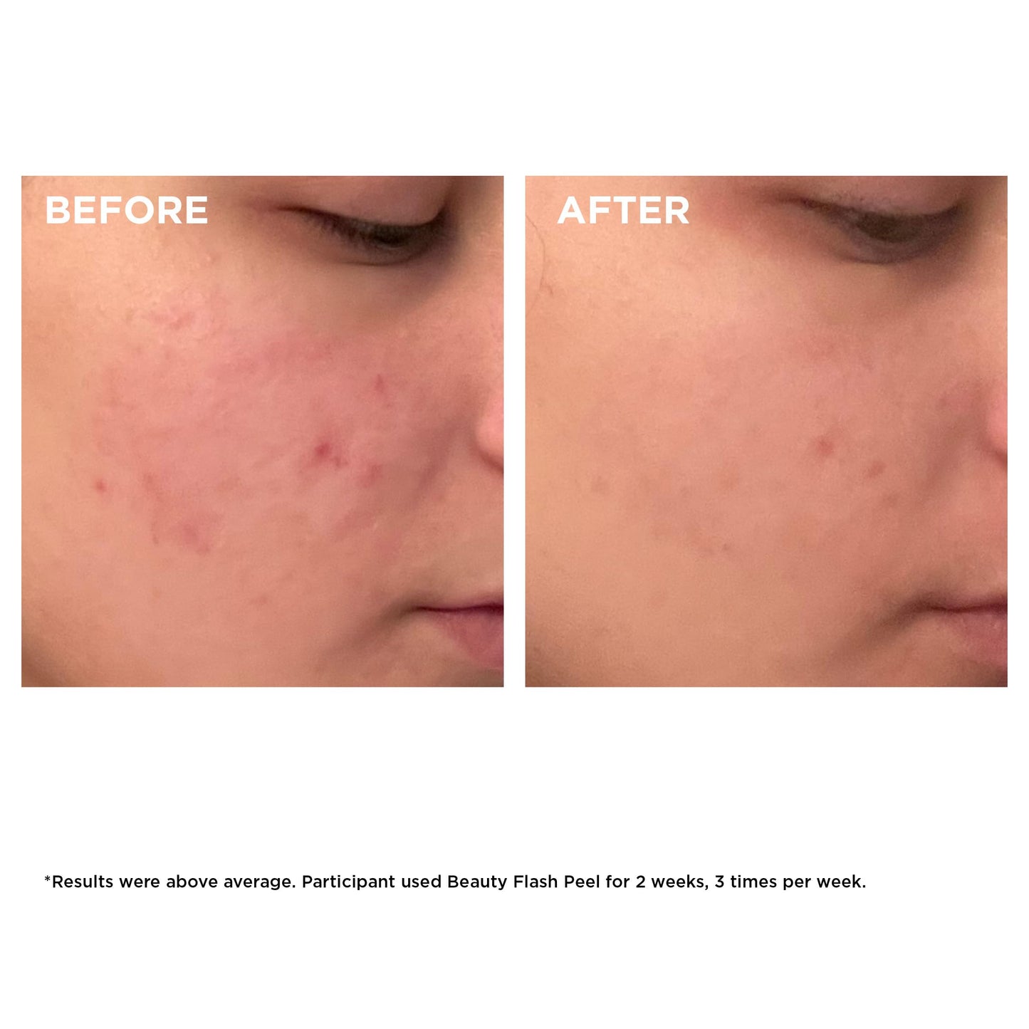 Clarins Beauty Flash Peel | 10-Minute At-Home Facial | Visibly Tightens Pores | Gently Eliminates Dead Skin Cells | Refines Skin Texture | Renews Radiance | Contains AHAs and BHAs | All Skin Types
