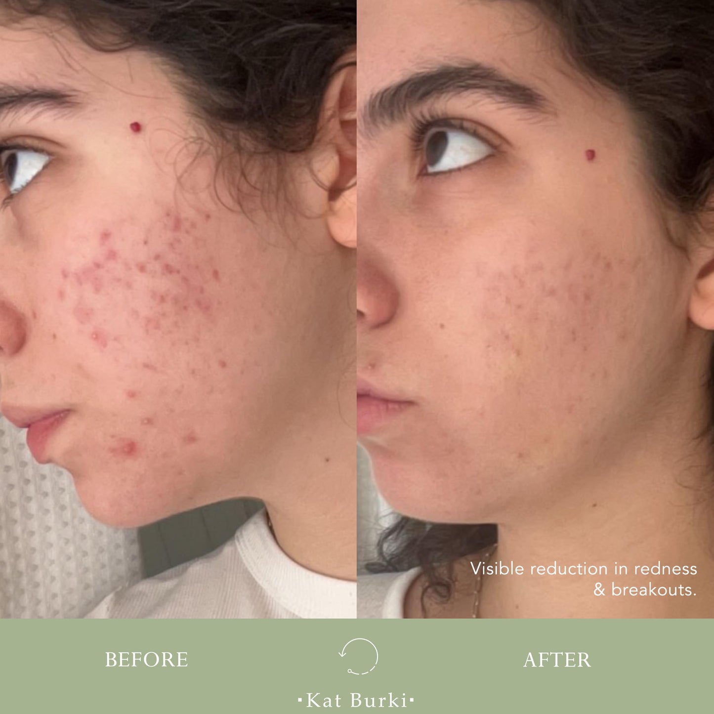 KAT BURKI VitaBiome Active Skin Optimizer With Vitamin C. Advanced Clearing and Redness Relief Face Mist for Breakout-Prone Skin