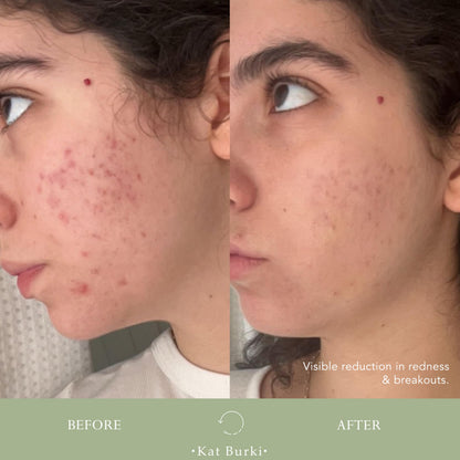 KAT BURKI VitaBiome Active Skin Optimizer With Vitamin C. Advanced Clearing and Redness Relief Face Mist for Breakout-Prone Skin