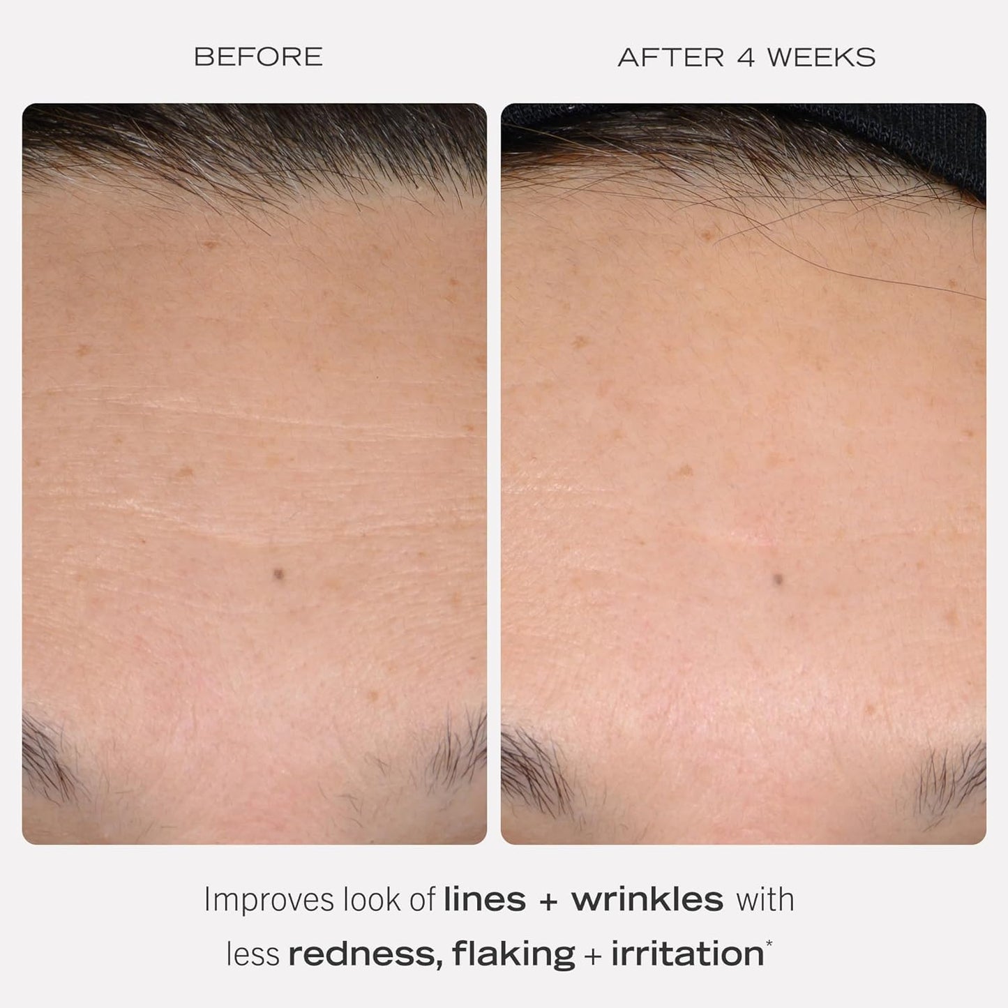 First Aid Beauty - 0.3% Retinol Complex Serum with Peptides, Designed for Sensitive Skin, Helps Visibly Improve Lines and Wrinkles with Less Irritation than Traditional Retinol, Non-Comedogenic, 1 oz