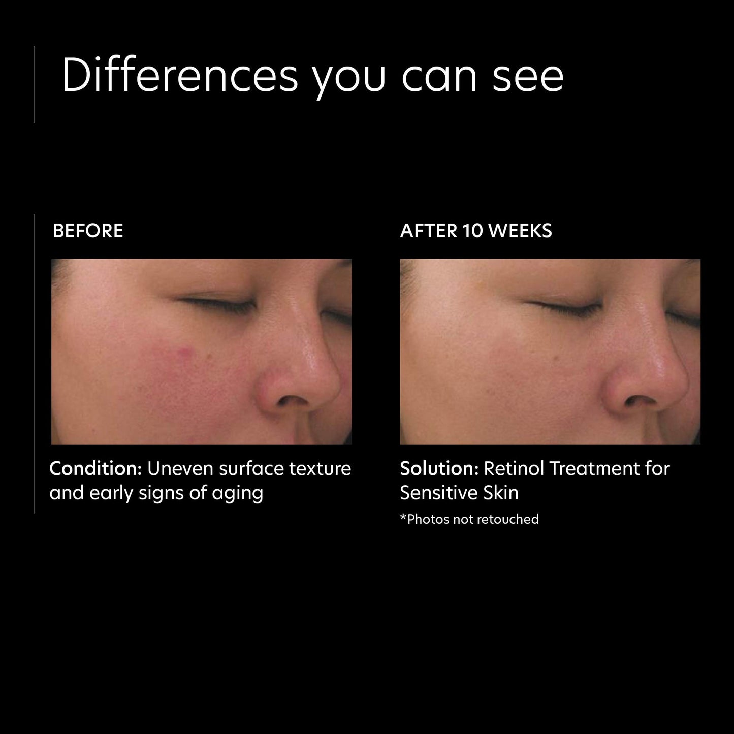 PCA SKIN Retinol Treatment for Sensitive Skin - Anti Aging Face Serum to Gently Reduce Redness & Minimize Fine Lines & Wrinkles - Contains Vitamin A & Hydrating Niacinamide (1 oz)