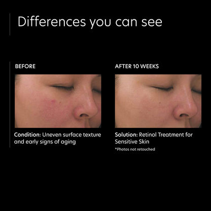 PCA SKIN Retinol Treatment for Sensitive Skin - Anti Aging Face Serum to Gently Reduce Redness & Minimize Fine Lines & Wrinkles - Contains Vitamin A & Hydrating Niacinamide (1 oz)