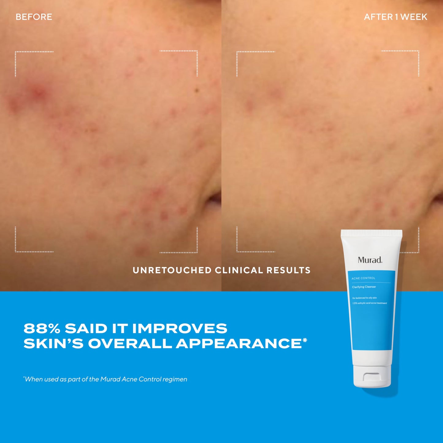 Acne Treatment Trial Kit – Salicylic Acid & Mandelic Acid for Clear Skin – Oil Control, Spot Treatment & Cleanser – Travel Size Skincare for Acne-Prone Skin