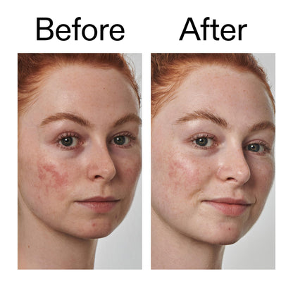 The INKEY List SuperSolutions Azelaic Acid 10% Serum, Fast-Absorbing Formula Helps Reduce Appearance of Redness and Soothes Skin, Leaves No White Cast, 1.01 fl oz