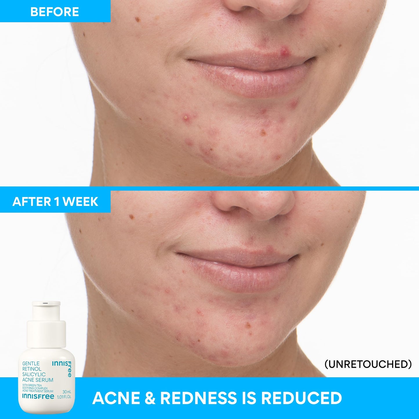innisfree Gentle Retinol Salicylic Acne Serum, Korean Face Treatment for Blemishes and Clear Skin