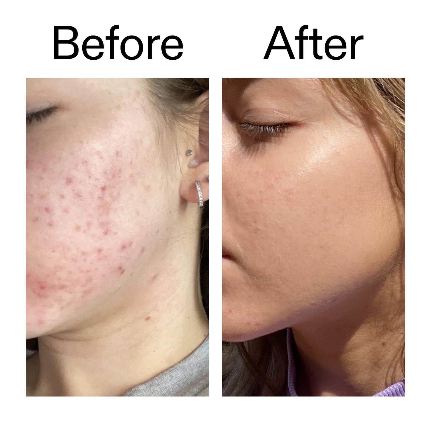 The INKEY List 10% Niacinamide Serum, Lightweight Oil Control Serum Helps with Blemishes and Appearance of Redness, Hydrating 1% Hyaluronic Acid 30ml, 1 fl oz