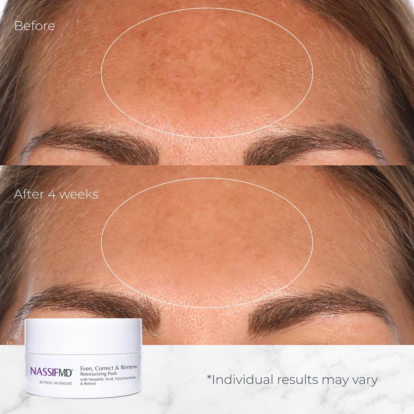 NassifMD Even, Correct & Renew Retexturizing Pads | Chemical Peel for Face | Whitehead, Closed Comedone and Acne Marks Skin Resurfacing Pads | Hyperpigmentation Treatment for Face