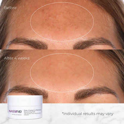 NassifMD Even, Correct & Renew Retexturizing Pads | Chemical Peel for Face | Whitehead, Closed Comedone and Acne Marks Skin Resurfacing Pads | Hyperpigmentation Treatment for Face