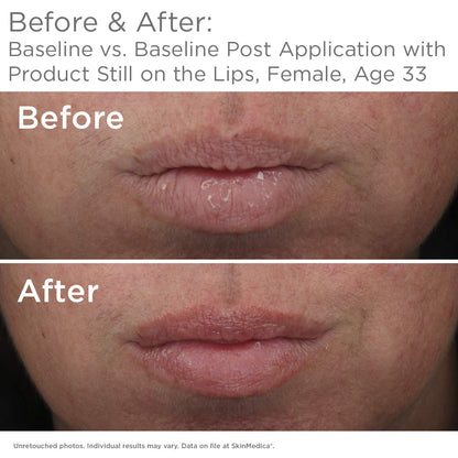 SkinMedica HA5 Smooth & Plump Lip System - Your Hydrating, Volumizing Lip Plumper for Visibly Fuller and Smoother Lips, 0.05 Oz