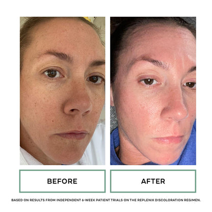Replenix Discoloration Essentials 3 Step Brightening Medical-Grade Trial Kit (Set Includes Travel-Size Glycolic Acid Resurfacing Cream, Vitamin C Pro Collagen Serum, Brightening Eye Cream)