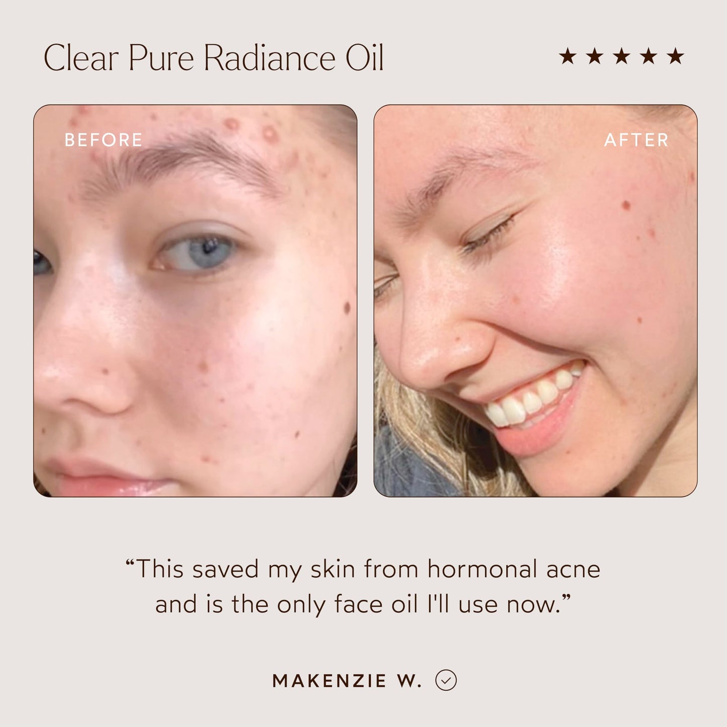 True Botanicals Clear Pure Radiance Oil | Oily Skin Types | Anti-Aging Face Oil for Acne Prone Skin | Treats Fine Lines & Wrinkles | Dermatologist Tested, All Natural, Vegan | 1 fl oz | 30 ml