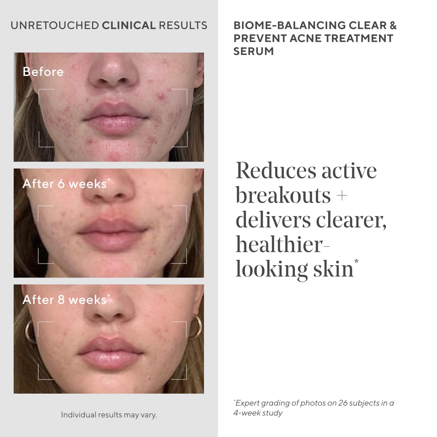 Acne Treatment Trial Kit – Salicylic Acid & Mandelic Acid for Clear Skin – Oil Control, Spot Treatment & Cleanser – Travel Size Skincare for Acne-Prone Skin