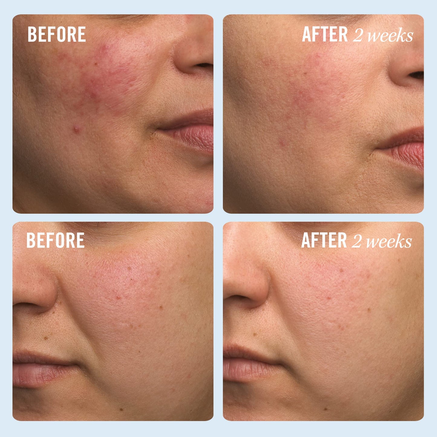 First Aid Beauty - Ultra Repair Cream - Intense Hydration Face & Body Moisturizer - Whipped Colloidal Oatmeal Clinically Proven to Strengthen Skin Barrier in 7 Days - Helps Relieve Eczema, 1 oz