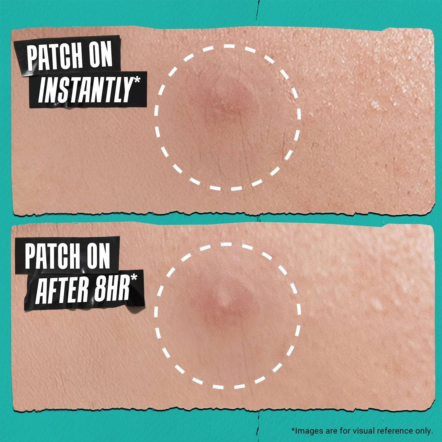Kiehl's Overnight Pimple Patches - Truly Targeted Invisible Hydrocolloid Blemish Patch, Absorbs Oil and Gunk, Treatment for Whiteheads and Zits, Shrinks Breakouts (22 Count)