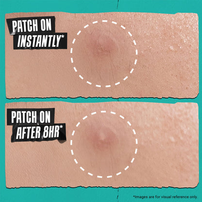 Kiehl's Overnight Pimple Patches - Truly Targeted Invisible Hydrocolloid Blemish Patch, Absorbs Oil and Gunk, Treatment for Whiteheads and Zits, Shrinks Breakouts (22 Count)