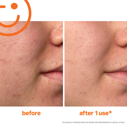 Kate Somerville ExfoliKate Intensive Exfoliating Treatment – Salicylic Acid and Lactic Acid Super Facial Scrub Improves Texture and Pores