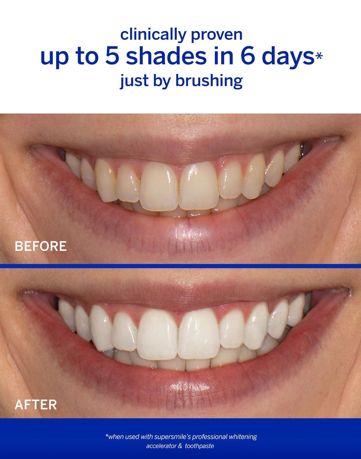 Supersmile Professional Whitening Accelerator - Powerful Whitening Without Sensitivity - Safe and Effective on Dental Restorations (8 oz)