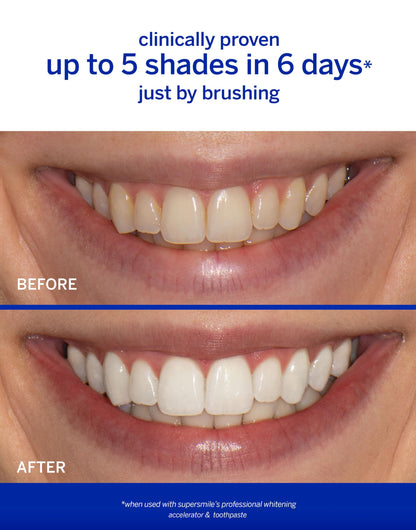 Supersmile Professional Whitening Accelerator - Powerful Whitening Without Sensitivity - Safe and Effective on Dental Restorations (8 oz)