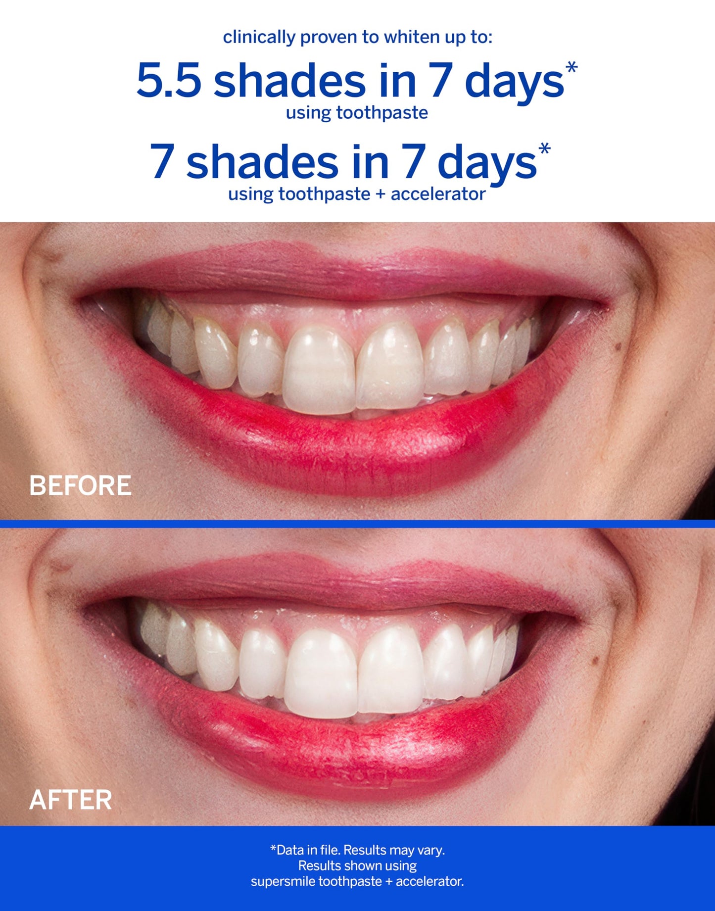 Supersmile Fluoride-Free Whitening System – 8 oz Professional Grade Whitening Toothpaste & Accelerator – Whitens up to 6 Shades & Strengthens Enamel