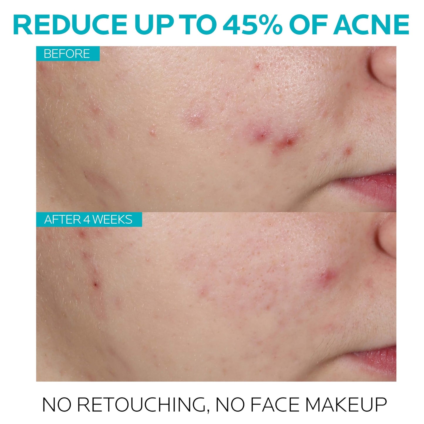 La Roche-Posay Effaclar 1.5% Salicylic Acid Serum, Acne Treatment For Face With Glycolic Acid & Niacinamide, Acne Serum Helps Clear Blackheads, Whiteheads, Pimples & Reduces Post Acne Marks