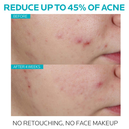 La Roche-Posay Effaclar 1.5% Salicylic Acid Serum, Acne Treatment For Face With Glycolic Acid & Niacinamide, Acne Serum Helps Clear Blackheads, Whiteheads, Pimples & Reduces Post Acne Marks