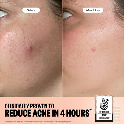 PEACE OUT Acne Healing Dots Hydrocolloid Pimple Patches, Acne Spot Treatment with Salicylic Acid, Retinol, and Aloe Vera for Blemishes and Breakouts, 40 Count