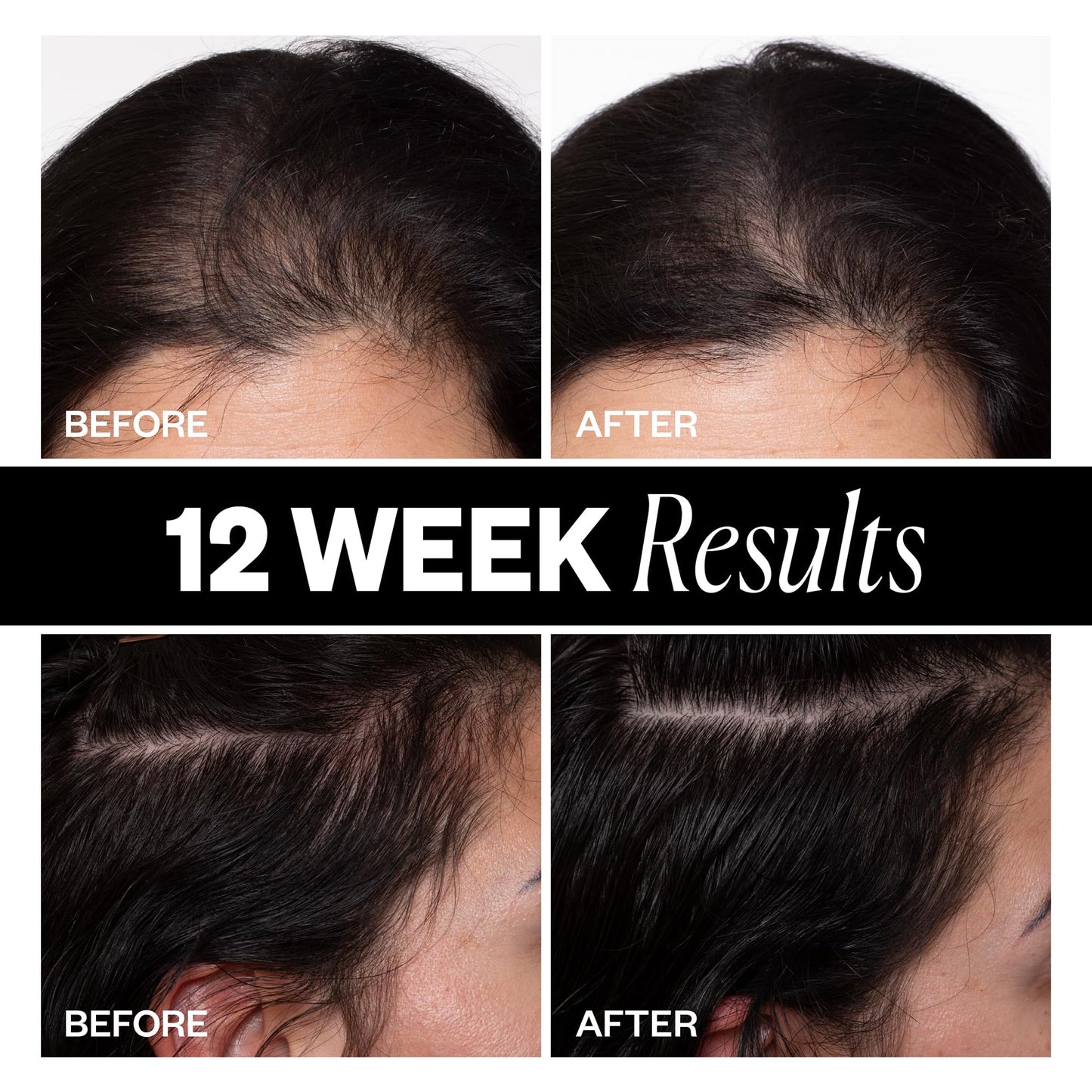 IGK Sponsored - Scalp Treatment for Hair Growth – Hair Thickening Serum for Women – Promotes Fuller, Thicker Hair – Scalp Serum for Hair Density and Thinning - 2.1oz