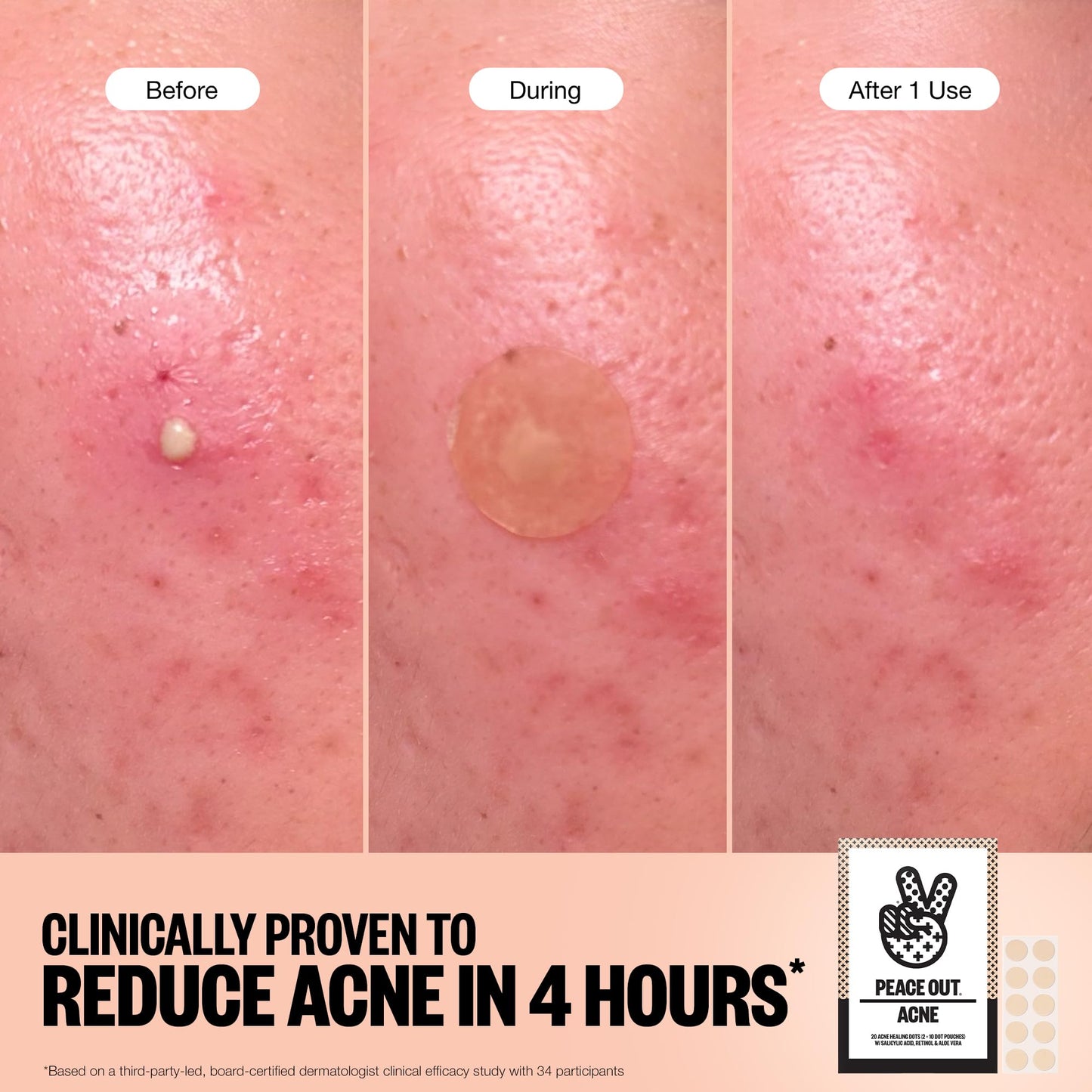 PEACE OUT Acne Healing Dots Hydrocolloid Pimple Patches, Acne Spot Treatment with Salicylic Acid, Retinol, and Aloe Vera for Blemishes and Breakouts, 40 Count