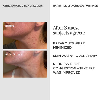 Murad Rapid Relief Acne Sulfur Mask – Clay Mask with Salicylic Acid, 5% Sulfur, and Austrian Peat Reduces Oil, Minimizes Breakouts, Reduces Pimple Size, and Unclogs Pores – 2.5 Fl Oz