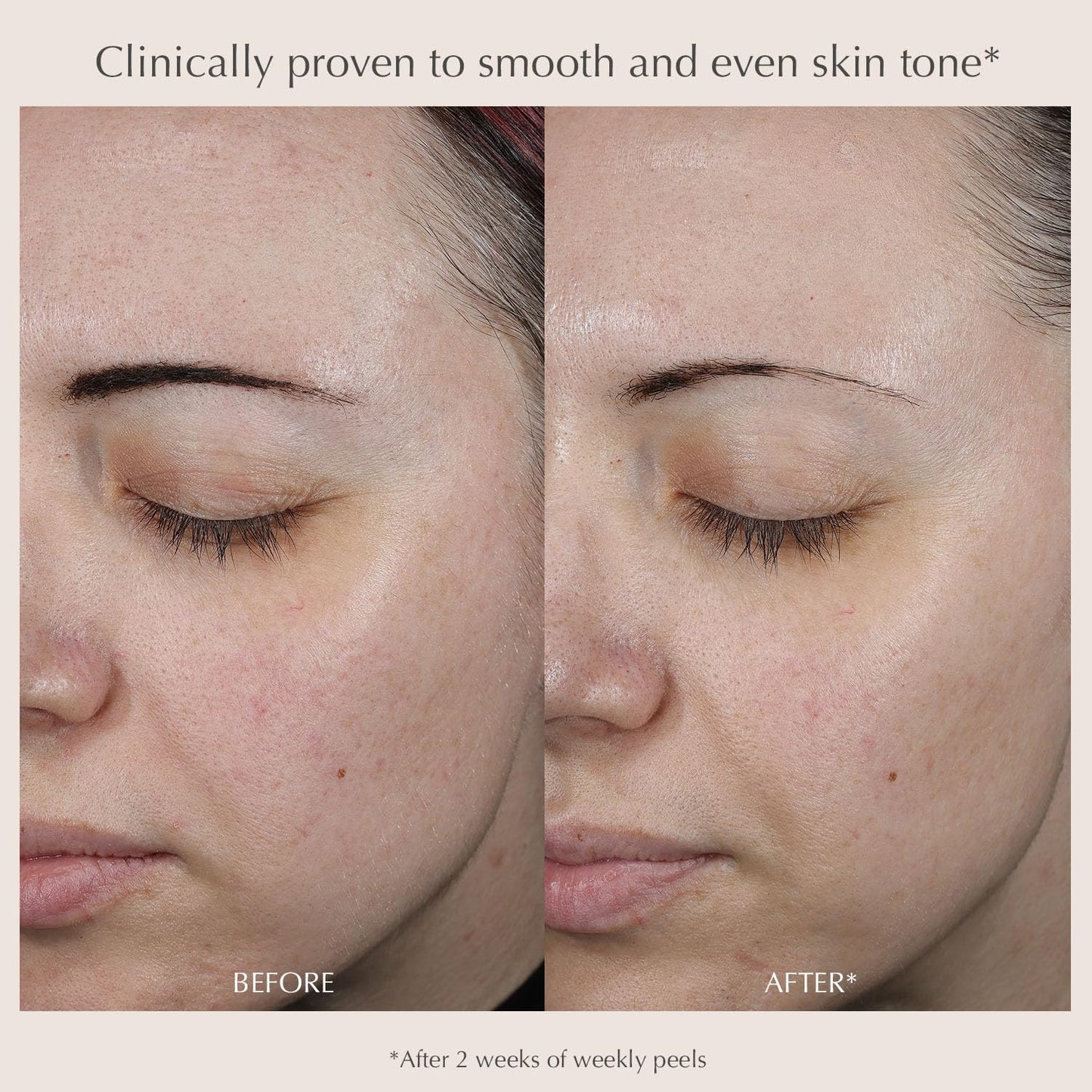 EXUVIANCE Performance Peel AP25, At-Home Chemical Peel with Glycolic Acid, Gently Refines Pores, Anti-Aging Peel, Treats Fine Lines, Wrinkles & Uneven Texture|Mandelic and Polyhydroxy Acids