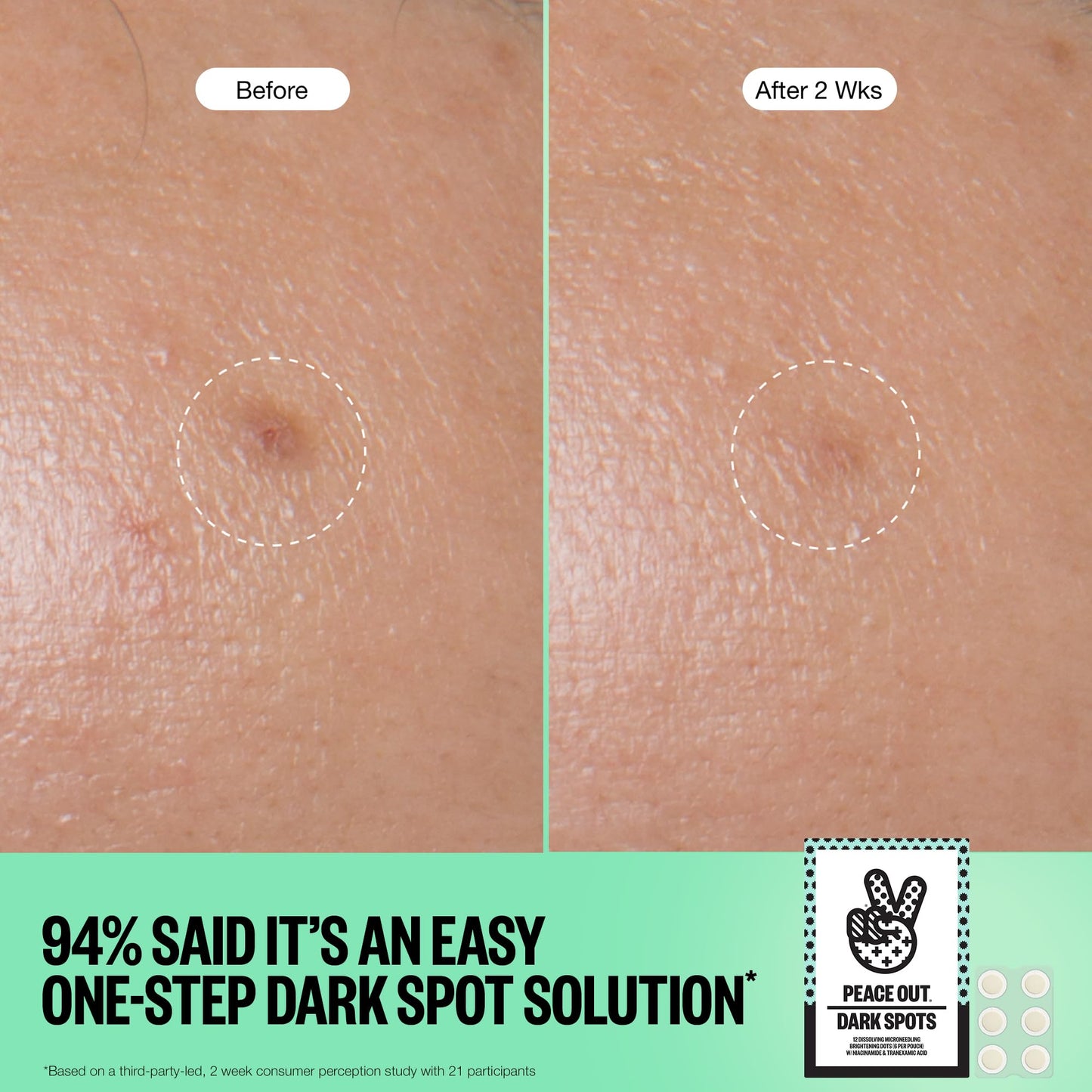 PEACE OUT Microneedling Dark Spot Brightening Dots, Targeted Dark Spot Corrector Patches for Face with Dissolving Microneedles, 12 Count