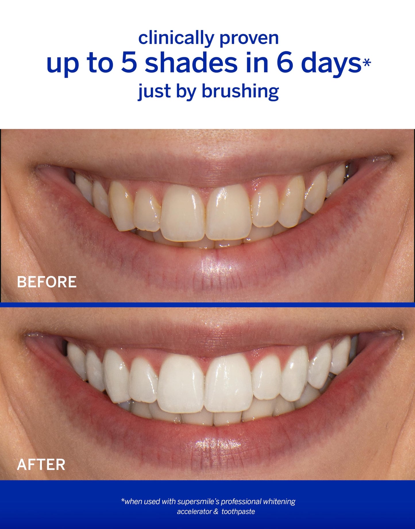 Supersmile Whitening System with Fluoride – Professional Grade 2-Step Whitening Toothpaste and Accelerator – Whitens Up to 6 Shades, 8 oz Each