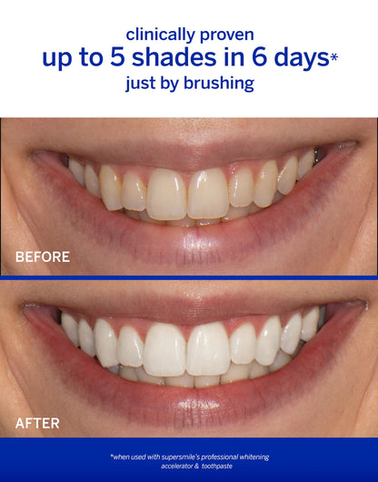 Supersmile Whitening System with Fluoride – Professional Grade 2-Step Whitening Toothpaste and Accelerator – Whitens Up to 6 Shades, 8 oz Each