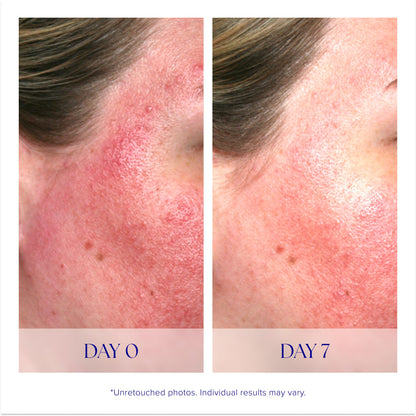 iS CLINICAL Pro-Heal Serum Advance+ - Antioxidant-Rich Vitamin C Serum, Calms Sensitivity & Irritation, Helps Redness, Anti-Aging