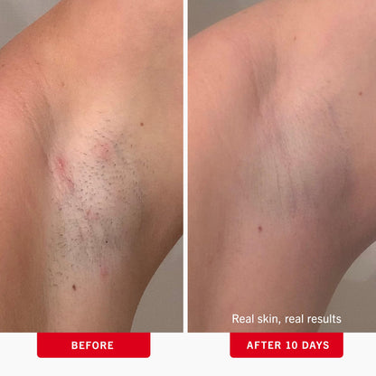 First Aid Beauty - Ingrown Hair Pads with BHA + AHA - Aftershave Treatment Pads to Help Prevent Razor Bumps for Men & Women - Exfoliate Underarms & Bikini Area - Compostable for Daily Use - 28 Pads