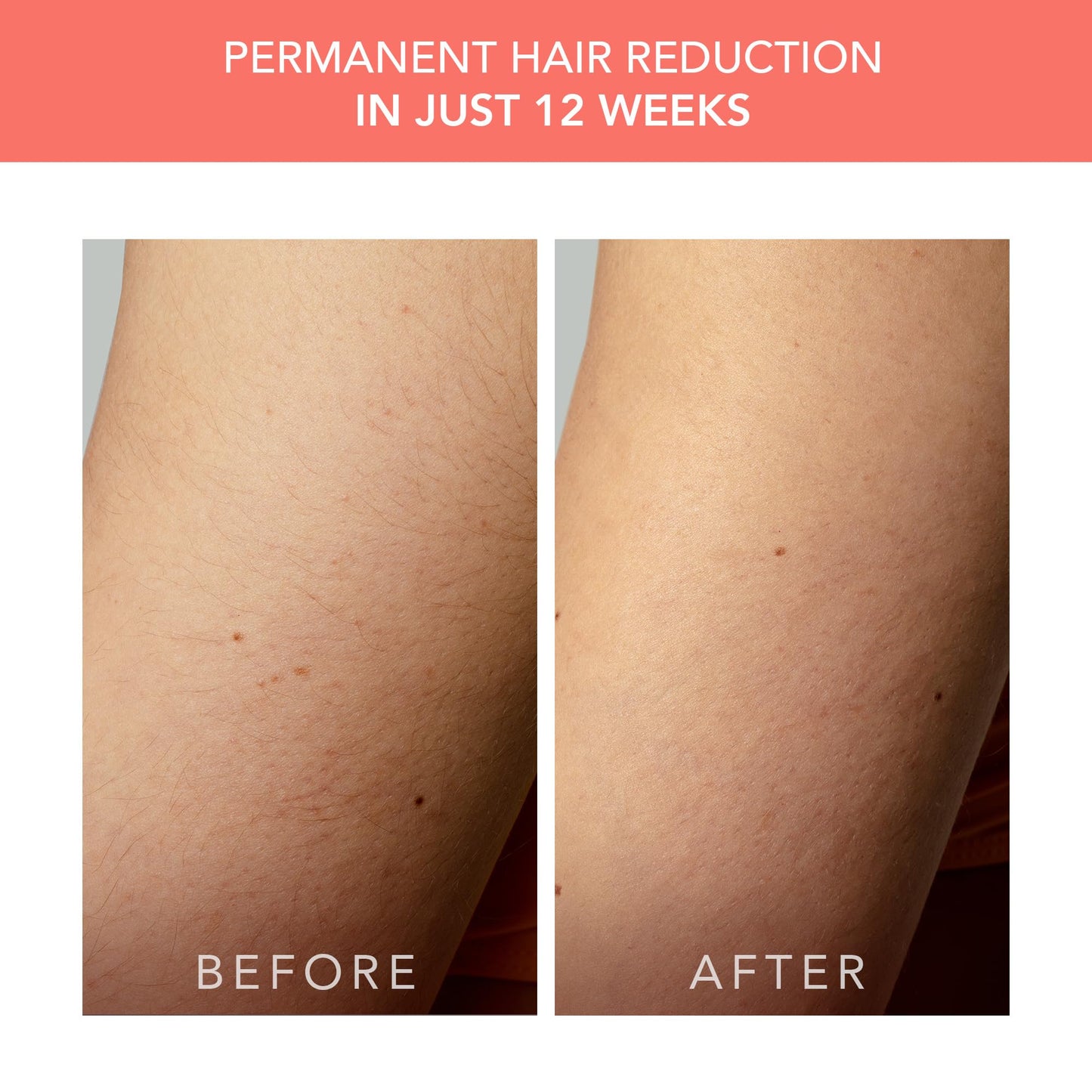 FOREO Peach 2 go IPL Hair Removal Device - Travel-Friendly Permanent Hair Removal - Laser Hair Removal - Body & Face - Painless Hair Removal - Skin Cooling & Silicone Shield - Customizable - Coral