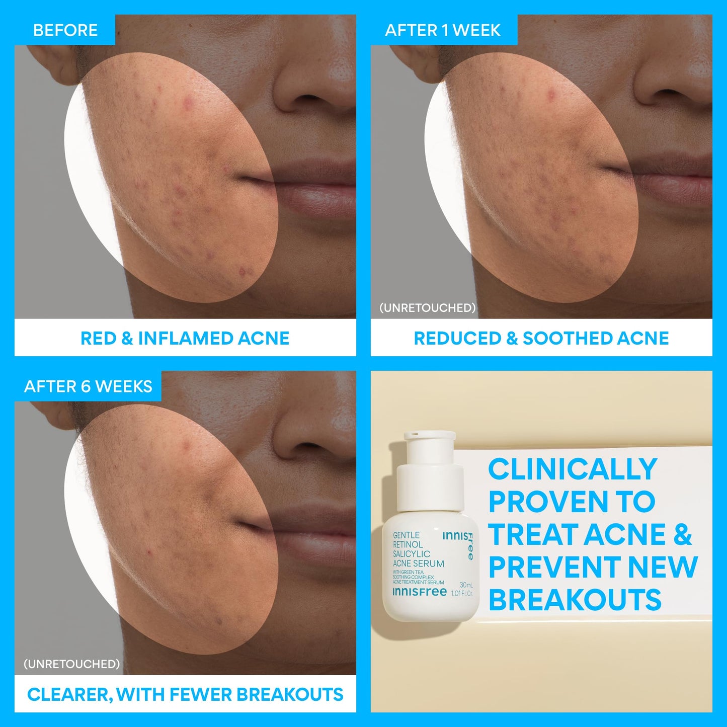 innisfree Gentle Retinol Salicylic Acne Serum, Korean Face Treatment for Blemishes and Clear Skin