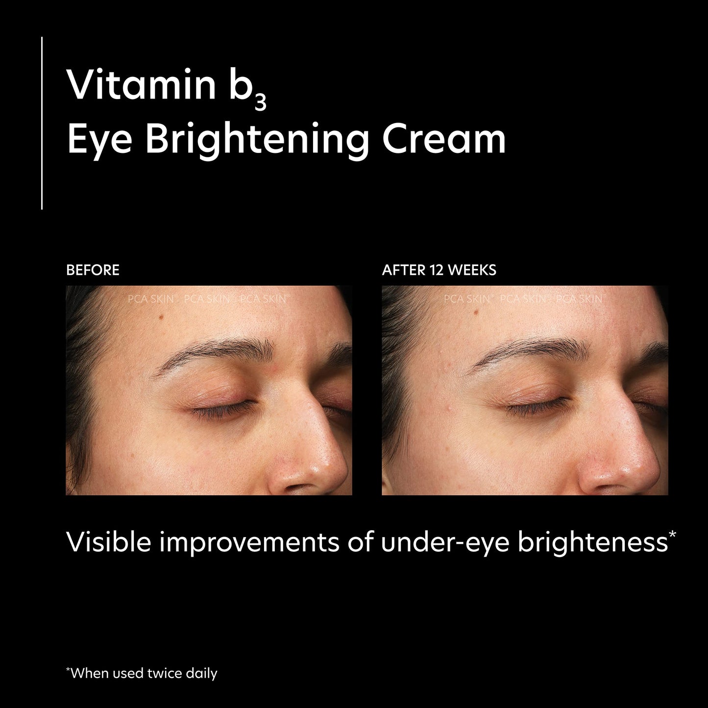 PCA SKIN Vitamin B3 Eye Brightening Cream, Eye Brightener For Bright Eyes, Dark Circles, Wrinkles, and Uneven Skin Tones, Anti Aging Eye Cream, Formulated with Niacinamide, 1 oz Tube