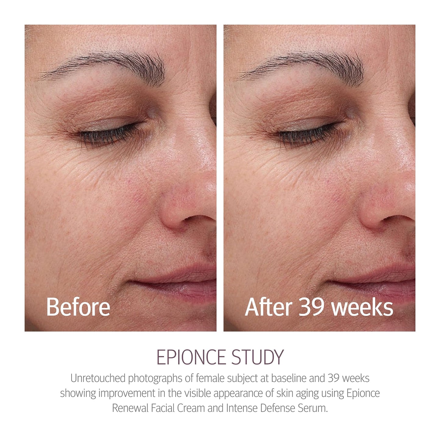 Epionce Renewal Facial Cream – Hydrating Anti-Aging Moisturizer | For Dry, Sensitive to Normal Skin | Fine Lines & Wrinkles | Dermatologist Skincare