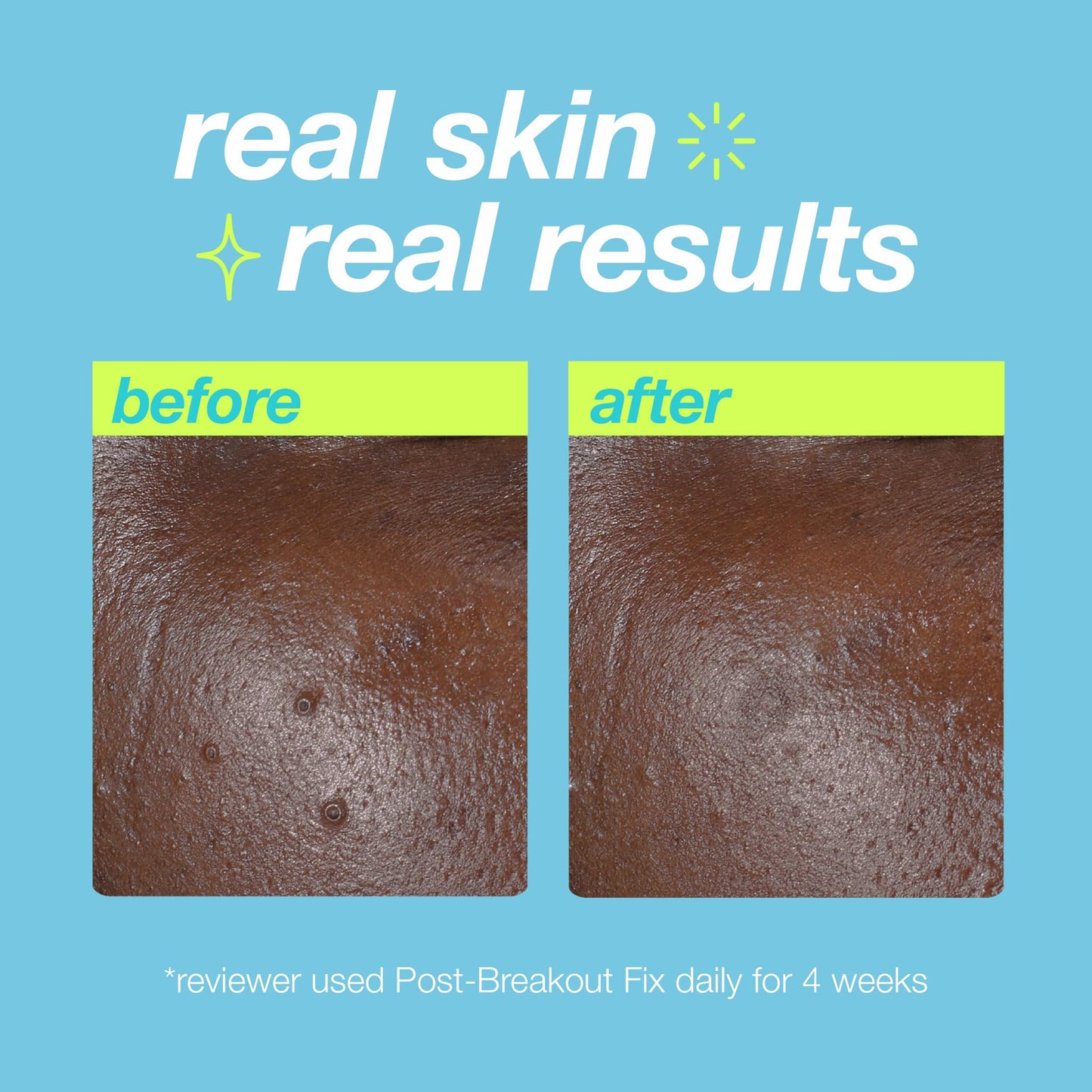 Dermalogica Clear Start Post-Breakout Fix, Acne Dark Spot Treatment with Salicylic Acid, Squalene & Hexylresorcinol, Fade + Brighten Acne Marks